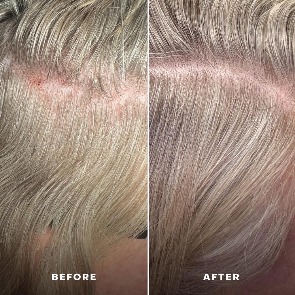 Everist Scalp Serum - Everboost for Dry & Brittle & Thinning Hair