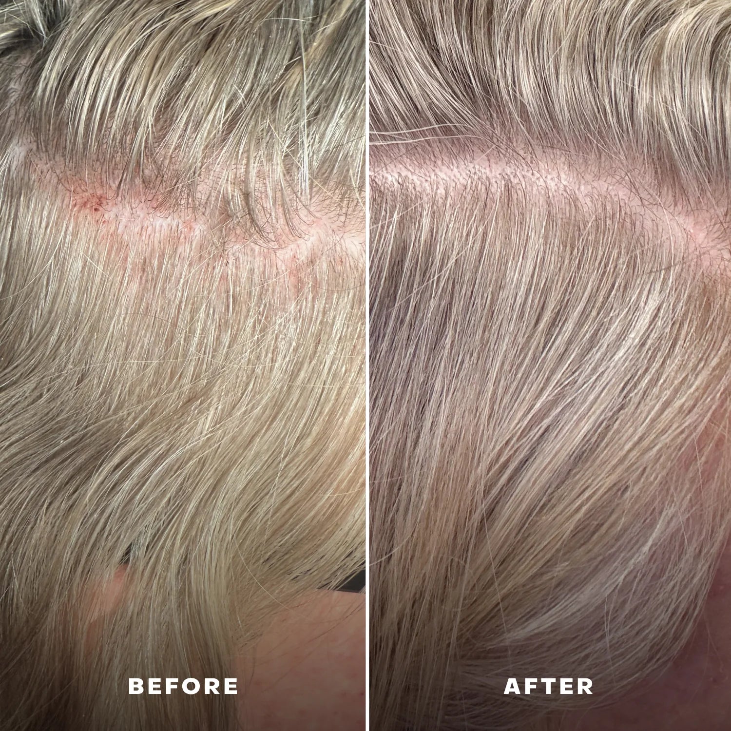 Everist Scalp Serum - Everboost for Dry & Brittle & Thinning Hair